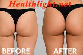 Brazilian Butt Lift
