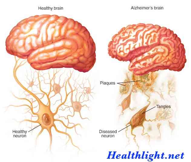 Alzheimer’s Disease