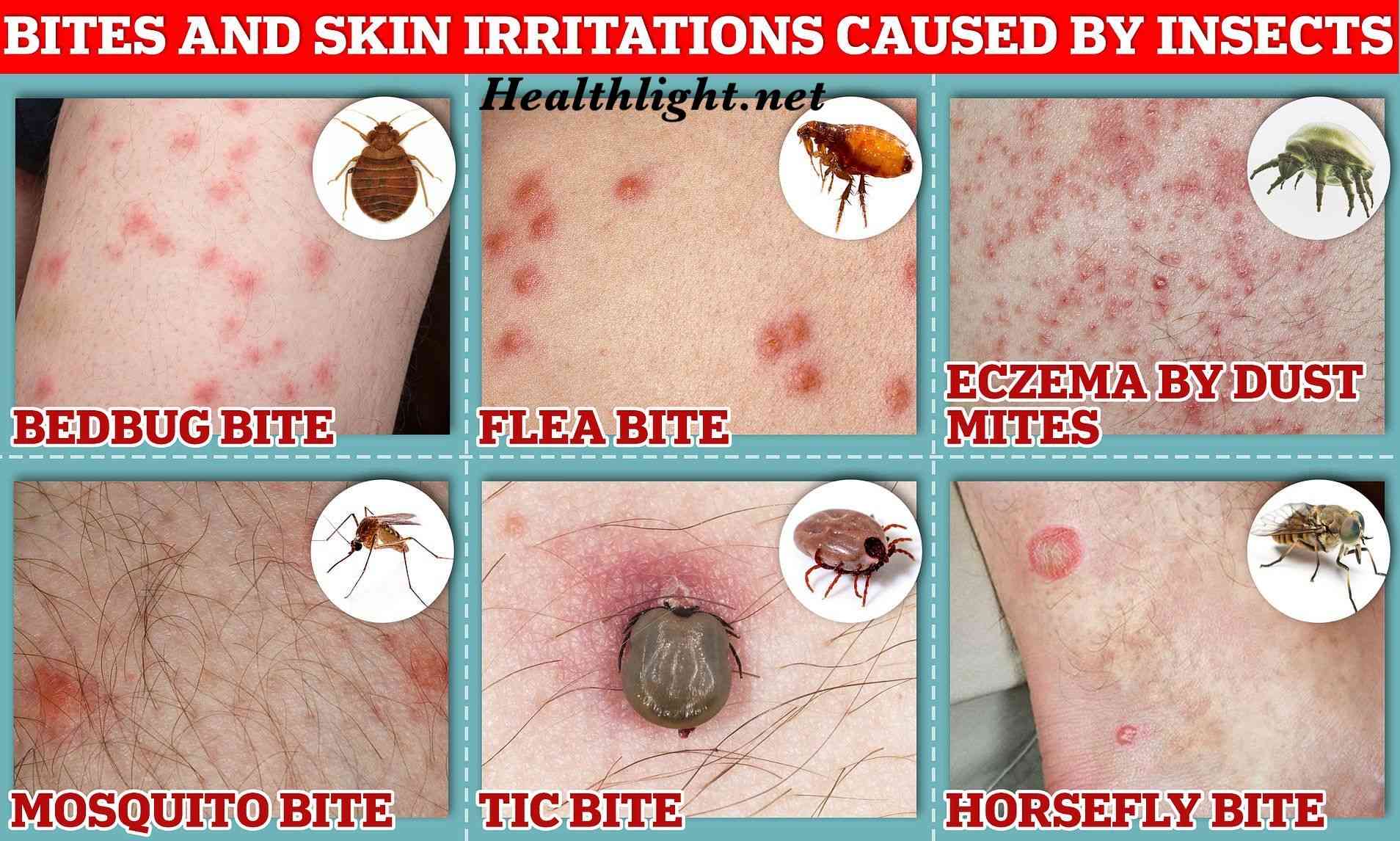 Bed Bugs Bites