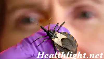 Chagas Disease