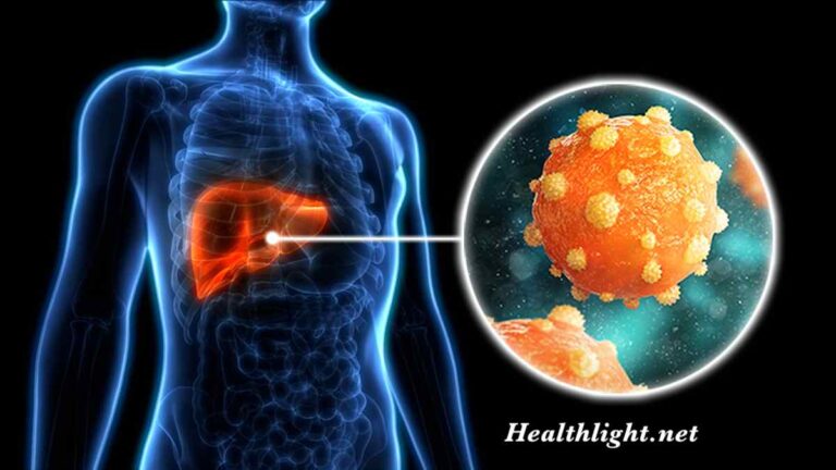Hepatitis B