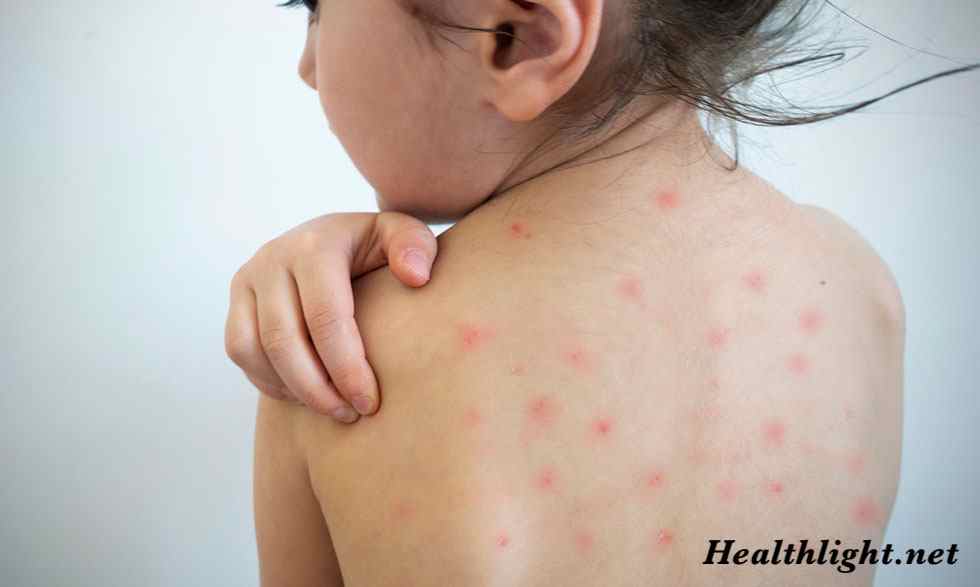 Measles