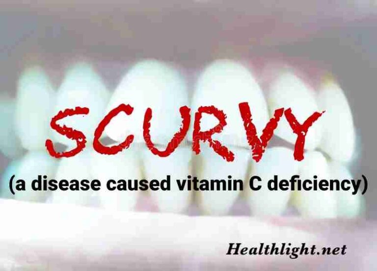 Scurvy