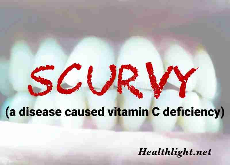 Scurvy